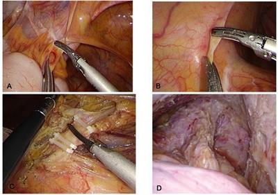 Application of the natural orifice specimen extraction surgery I-type E method combined with 3D laparoscopy in sphincter-preserving surgery of low rectal cancer
